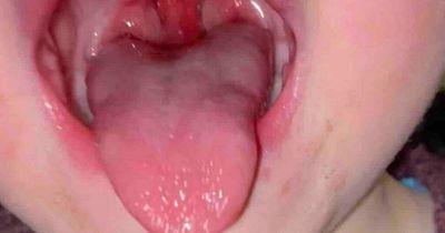 Toddler with tonsils so big they stop him breathing must wait year for surgery