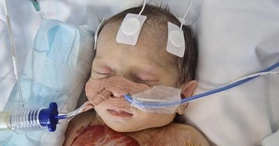 Baby born with half a heart and given ‘no chance of survival’ is now thriving - despite an hour-long cardiac arrest