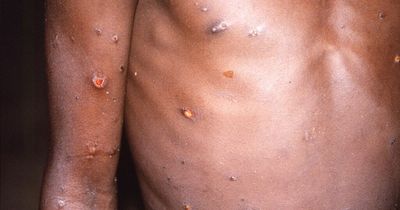 Leeds is monkeypox virus hotspot as new cases soar