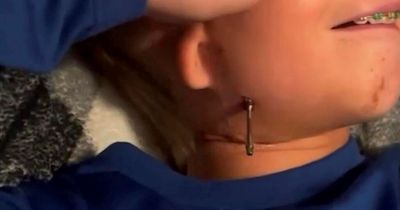 Boy, 10, has to screw jaw forward so he can eat, talk and swallow