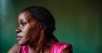 Woman badly scarred by acid attack thought she'd never find love again - but is now set to marry