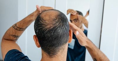 Men who go bald could have increased risk of heart disease, experts warn