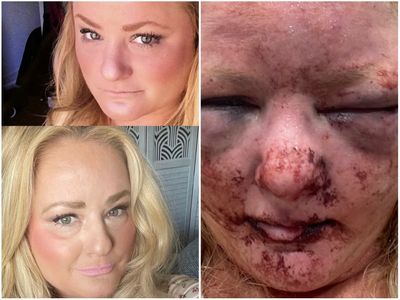 Rape survivor shares shocking photo of her injuries to warn others: ‘I was fighting for my life’