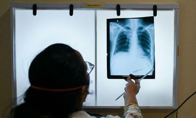 Global tuberculosis cases increase for the first time in 20 years