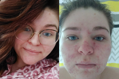 Young mother who became a recluse due to acne finds ‘life-changing’ cure