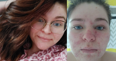 Mum who was recluse after baby sparked five-year acne saved by birthday present