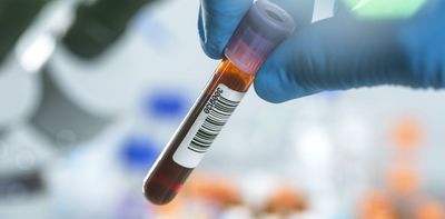 A blood test that screens for multiple cancers at once promises to boost early detection