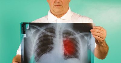 Irish people neglecting lung cancer symptoms due to expensive GP bills