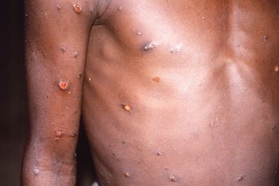 Monkeypox transmission ‘occurs up to four days before symptoms appear’