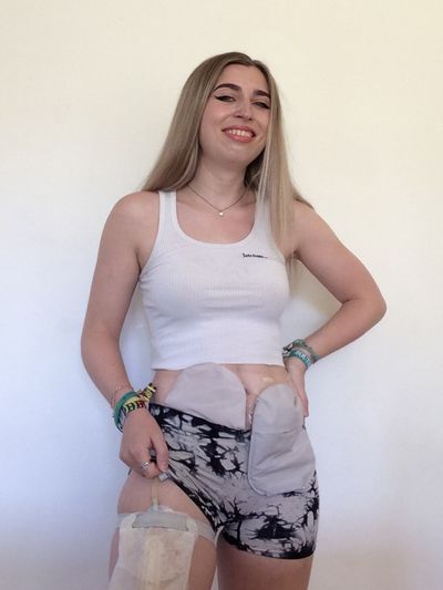 Young woman reveals three bowel cancer symptoms everyone should know