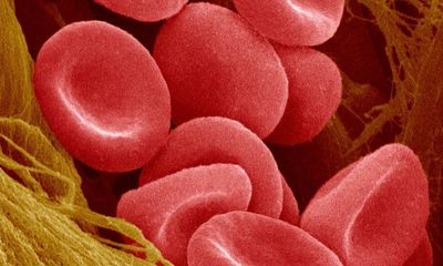 New hope for sickle cell patients as UK trial of lab grown red blood cells begins