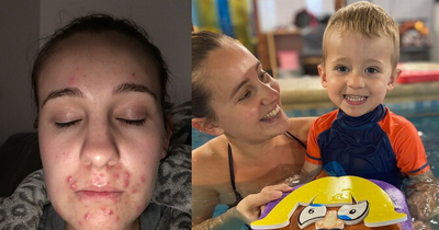 Mum who 'didn't want to be seen' now has clear skin thanks to £9 Bedew Skin acne products