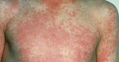 Scarlet Fever outbreak in Scotland prompts fears with cases on the rise