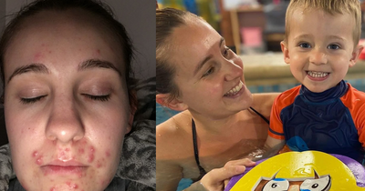 Mum who 'didn't want to be seen' now has clear skin thanks to €10 product