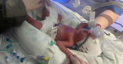 Leeds baby girl fighting for her life after being born 13 weeks early
