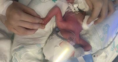Baby girl fights for life after being born 13 weeks premature, weighing just two pounds