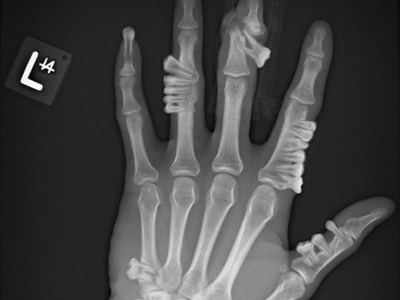 VIRAL: Bizarre image of Vitamin D deficiency is actually photoshopped!!