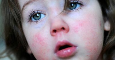 Scarlet fever warning signs after outbreak in Scotland prompts fears