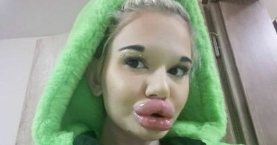 'I have the world's biggest lips - doctors tell me I could die but I won't stop'