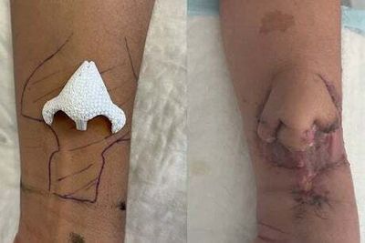 Woman in France has nose grown on her arm from 3D-printed biomaterial then grafted onto her face