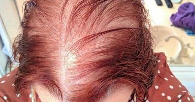 Woman who rubbed onion on scalp to help hair grow now embraces her alopecia after 'years of hiding'