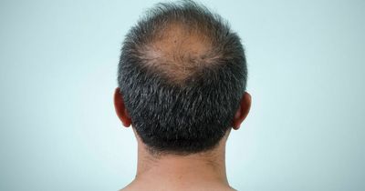 Scientists discover simple patch that could help cure baldness