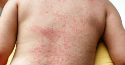 Victorian disease symptoms as UK cases 'higher than usual'