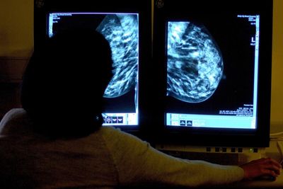 Scientists find targeting tumour ‘scaffolding’ slows breast cancer