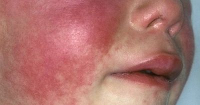 Scarlet fever warning as parents urged to look out for symptoms in children