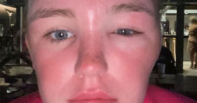 Brit woman's warning as face DOUBLES in size after she gets sun poisoning on holiday