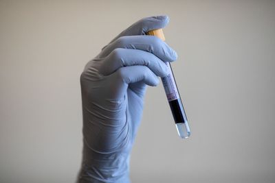 Blood test ‘could detect breast cancer up to two years before diagnosis’ OLD