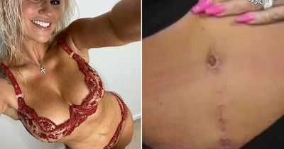 Kerry Katona says she's been left with two belly buttons after botched secret tummy tuck