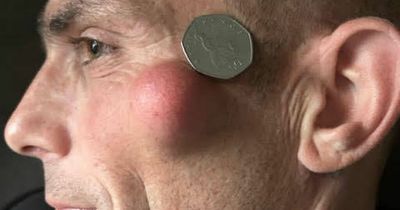 Dad grows 'gruesome' cyst on cheek the size of a 50p coin - and his kid won't go near him