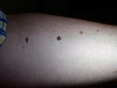 Skin cancer advertising blitz launched