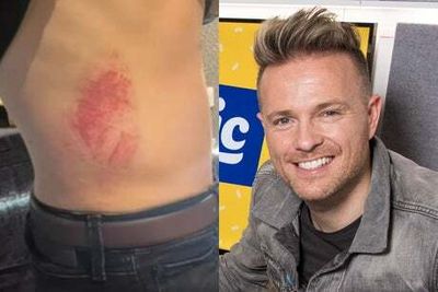 Westlife’s Nicky Byrne shows off injuries after being left ‘battered and bruised’ falling through stage