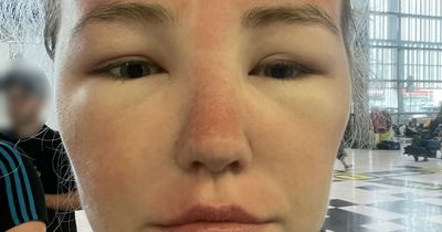 Holidaymaker deformed by sun poisoning feared airport security would reject her