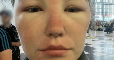 "Everyone was looking": Woman's face doubles in size after serious sun poisoning