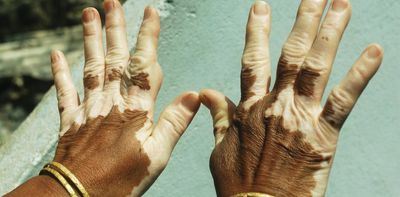 Nigerians with vitiligo face stigma – a skin doctor calls for better support