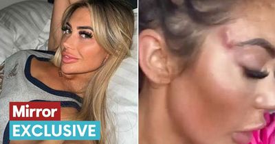 Chloe Ferry needs a skin graft to fix 'fox eye' damage but is wary of more surgery