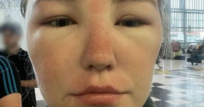 Woman left 'deformed' by sun poisoning on holiday after face doubled in size