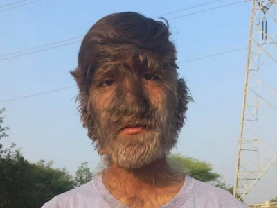 Werewolf syndrome: Key points on the rare condition a MP boy is suffering from