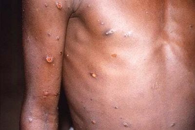 Mpox: WHO renames monkeypox amid racism and stigma