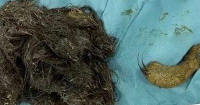 Surgeons remove 3kg hairball after teen girl pulls out almost all of her hair and eats it