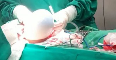 Incredible moment baby is born while still inside perfectly intact amniotic sac