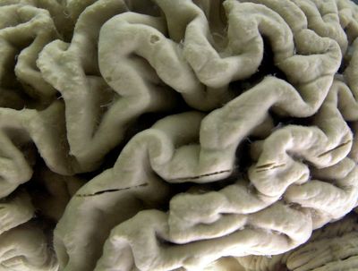 Drug slows Alzheimer's but can it make a real difference?