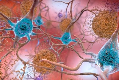 Tech & Science Daily podcast: Alzheimer’s disease drug breakthrough