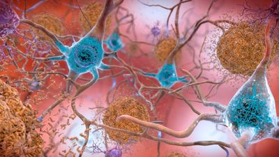 New Alzheimer's drug shows modest slowing of early disease progression