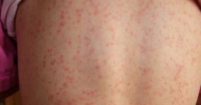 Scarlet fever: What are the symptoms, how infectious is it, and how to treat it