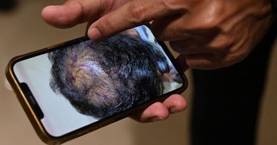 Man dies after botched hair transplant causes head to swell as organs fail