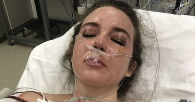 Bride forced to call off wedding after her face 'melts' in fire caused by French fries